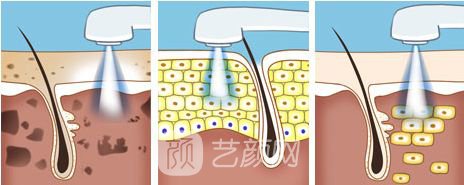 光子嫩肤是什么手术