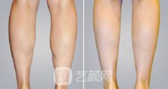 小腿吸脂瘦小腿术前术后果?
