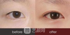 2019眼部整容费用