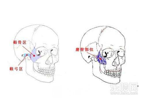 颧骨内推术后要注意什么?