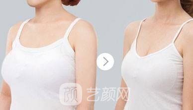 乳房缩小需要多少钱?