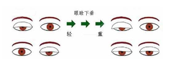 上睑下垂可以通过埋线矫正么?