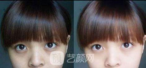 【超声波去黑眼圈果好吗？超声波去黑眼圈果图~】