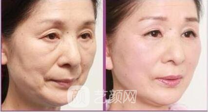 【伊维兰除皱果怎么样?伊维兰除皱果图~】