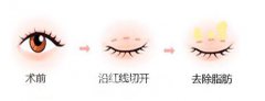整形者的自述——郑州做眼部整形手术的费用？