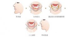 徐州假体隆下巴多少钱