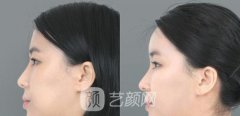 额头自体填充多少钱，丰个额头真的不贵!