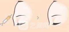 自体填充额头多少钱，价格都是问出来的!