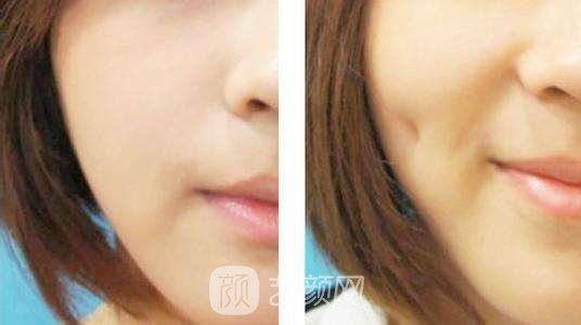 人造酒窝有危害吗?