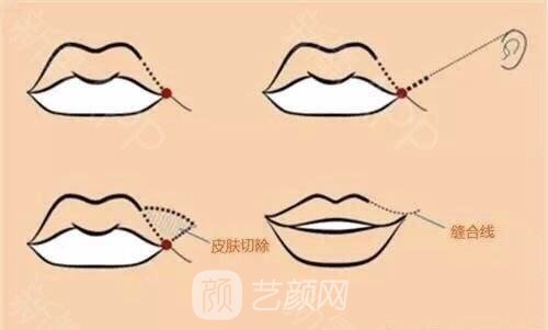 嘴角上扬术有危险吗?