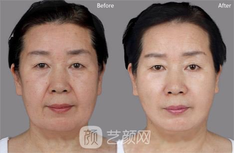 第三代塑美级有副作用吗?