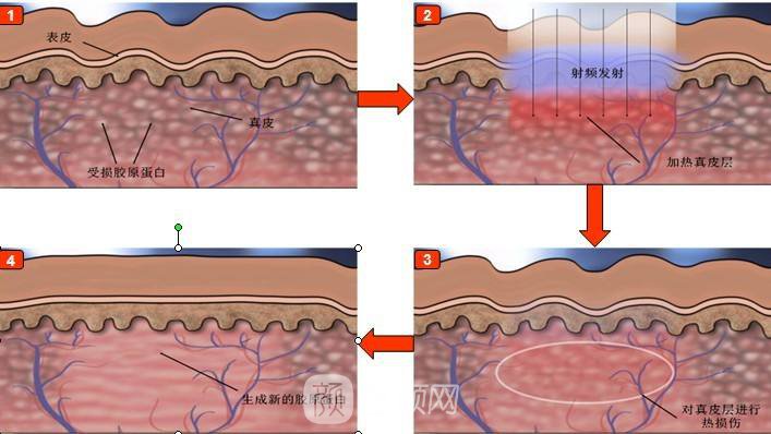 第三代塑美级有副作用吗?