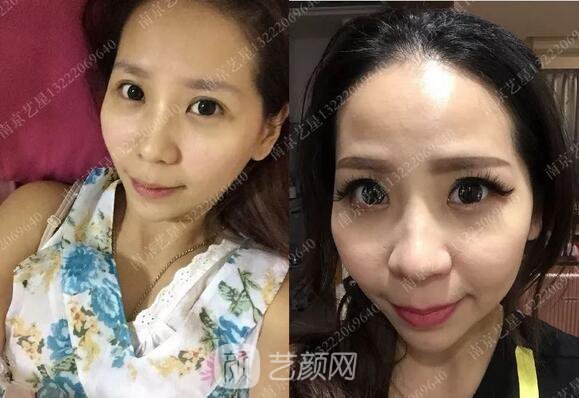 只需要5分钟，我的鼻子变高了！——南京艺星玻尿酸隆鼻~