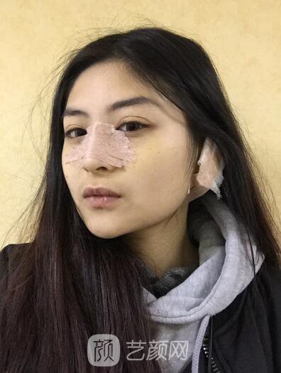 割双眼皮案例