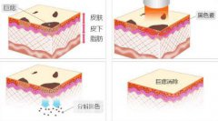 体表小肿瘤切除术需要多少钱?
