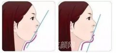 短颌矫正术需要多少钱?