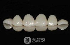 广州全瓷烤瓷牙价格?