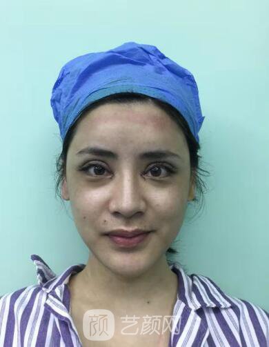 开眼角手术的整形常识，真人案例分享~