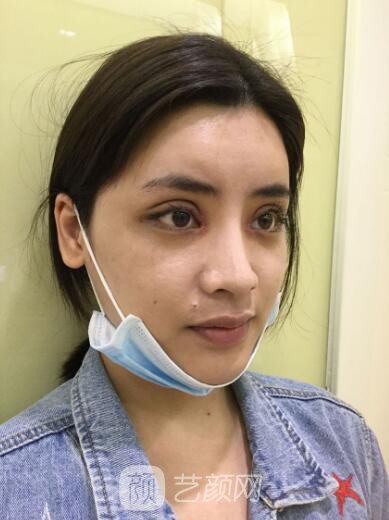 开眼角手术的整形常识，真人案例分享~