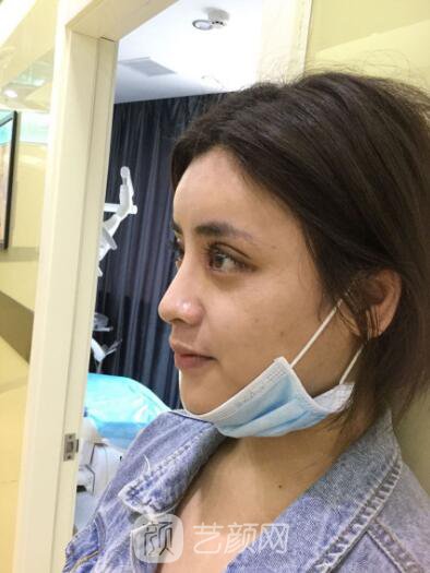 开眼角手术的整形常识，真人案例分享~