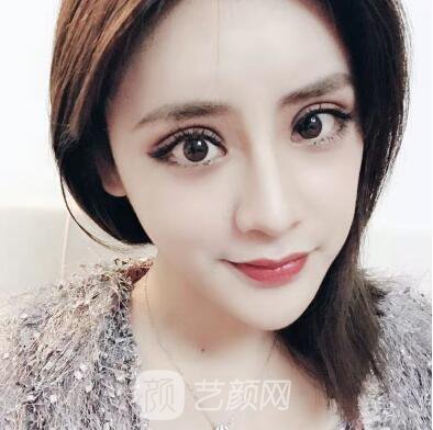 开眼角手术的整形常识，真人案例分享~