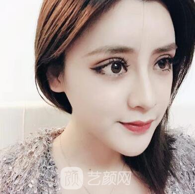 开眼角手术的整形常识，真人案例分享~