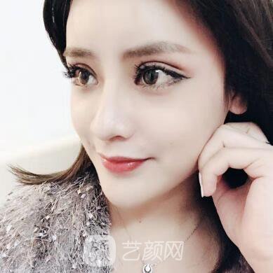 开眼角手术的整形常识，真人案例分享~