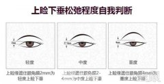 公立医院上睑下垂矫正什么价位?