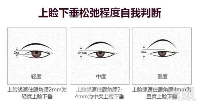 公立医院上睑下垂矫正什么价位?