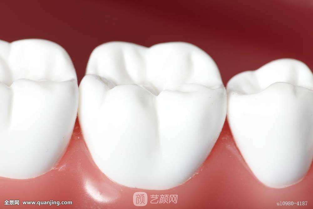 登腾种植牙是什么?