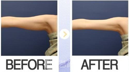 吸脂手臂手术多少钱?