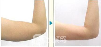 吸脂手臂手术多少钱?