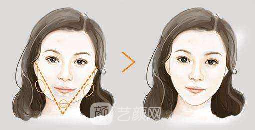 上海磨下颌角多少钱?