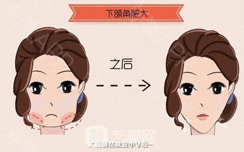磨下颌角前后果图，磨下颌角果好吗?
