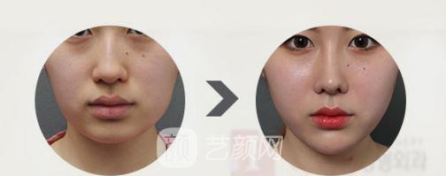 磨下颌角前后果图，磨下颌角果好吗?