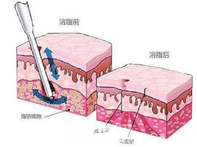 vline减脂多久有?