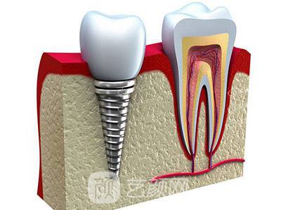 上海九院种植牙多少钱?
