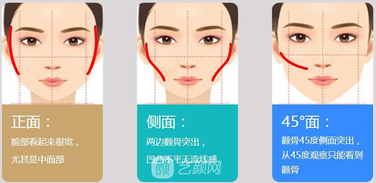 3d颧骨内推多少钱?