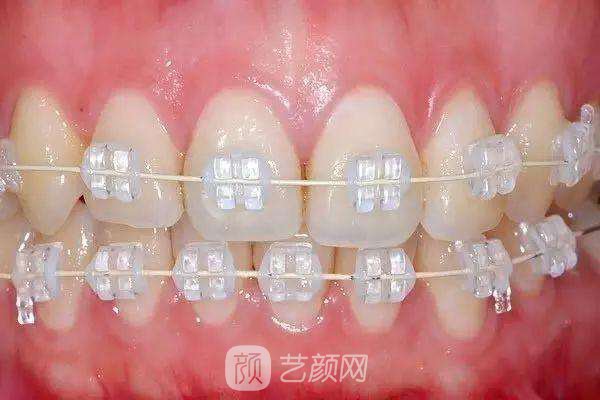 透明陶瓷托槽矫正多久时间?