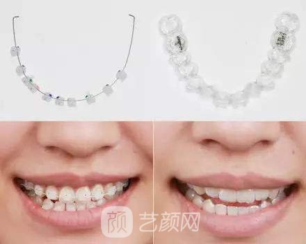 透明陶瓷托槽矫正多久时间?