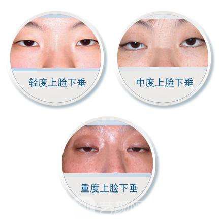 上睑下垂矫正术后护理?