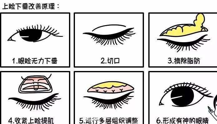 上睑下垂矫正术后护理?
