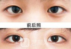 沈阳眼部整形手术价格，影响因素！