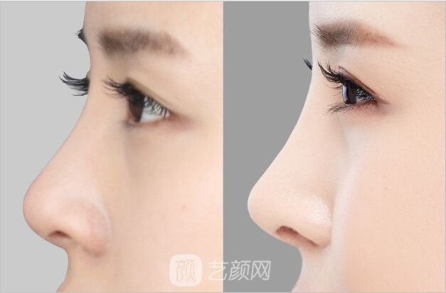 自体筋膜隆鼻有副作用吗?