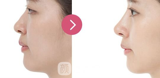 自体筋膜隆鼻有副作用吗?