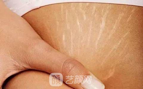 长肥胖纹怎么办?