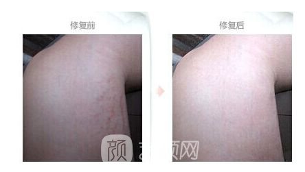 长肥胖纹怎么办?