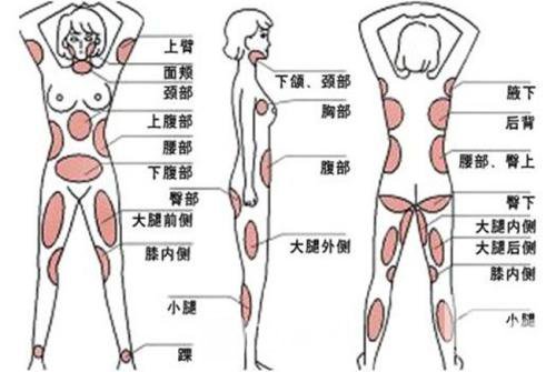 360度环形吸脂果怎么样?