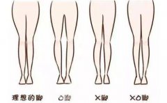 怎么矫正x型腿，需要多少钱?