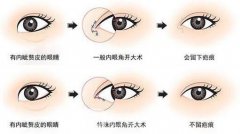 杭州开眼角加割双眼皮多少钱